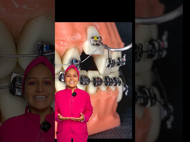 With braces, any tooth can be straightened. #brackets #dentist #orthodontics
