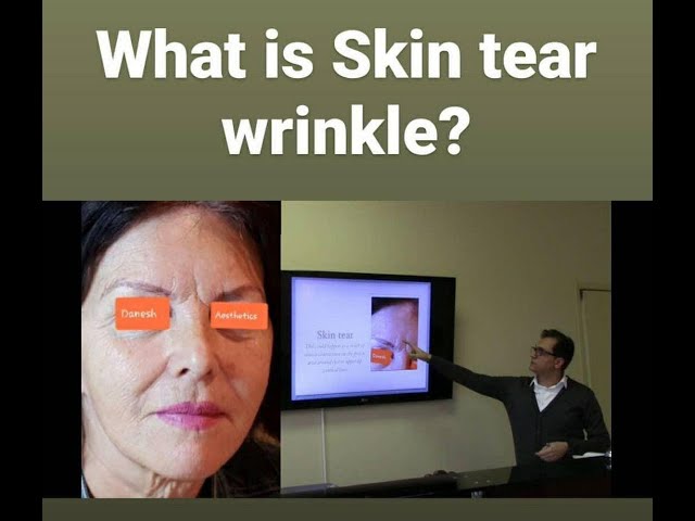 ➡️What is a  Skin tear wrinkle? Is it treatable? How can you avoid these types of creases?