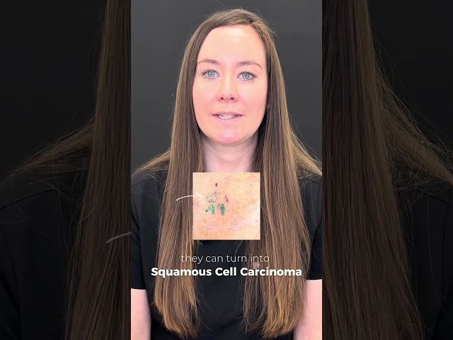 How to Spot Early Warning Signs of Skin Cancer Before Its Too Late