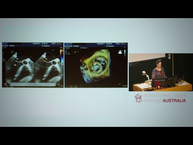 Quantification of mitral regurgitation - Dr Lisa Simmons
