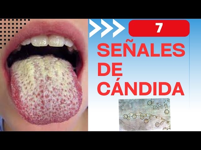 7 signs that you might have a Candida infection