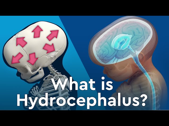 What is Hydrocephalus and Why Does Fluid Build Up in the Brain?