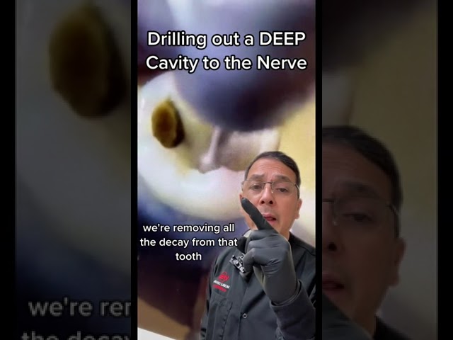 Preparing for a Root Canal: Removing the Cavity | In Office to Hands On Dental Training