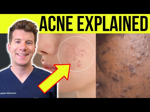 Doctor explains ACNE | Causes, symptoms, treatment and more!