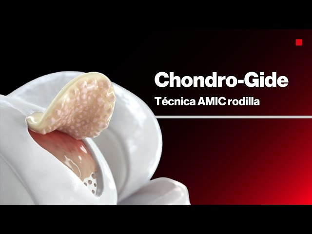 AMIC CHONDRO-GIDE® | Reparación de cartílago en la rodilla