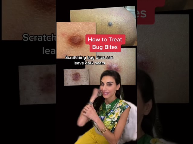 How to Treat Bug Bites #shorts | SkinByDrAzi