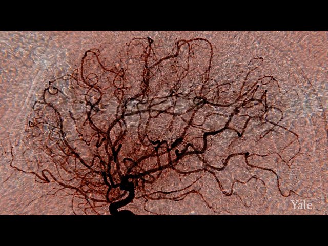3 Critical Breakthroughs in Stroke Research at Yale