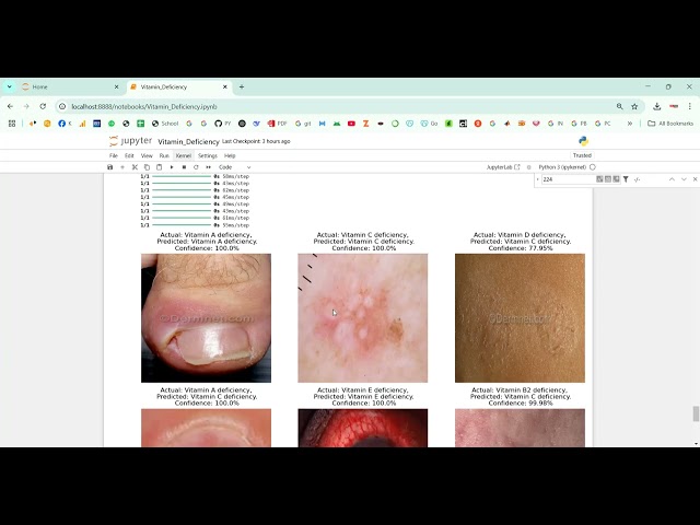 Vitamin Deficiency Detection Using Image Processing in Python Projects