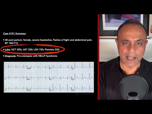 ECG Case #31 | ECG Breakdown