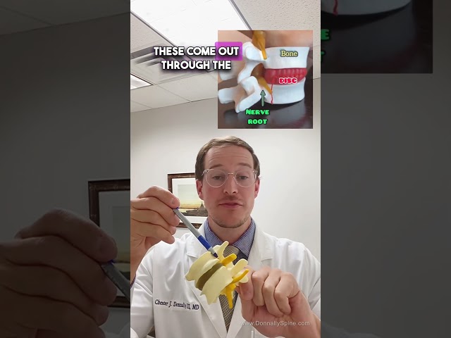 𝑺𝑪𝑰𝑨𝑻𝑰𝑪𝑨 𝑴𝑨𝑫𝑬 𝑺𝑰𝑴𝑷𝑳𝑬 (Spine Surgeon Explains)