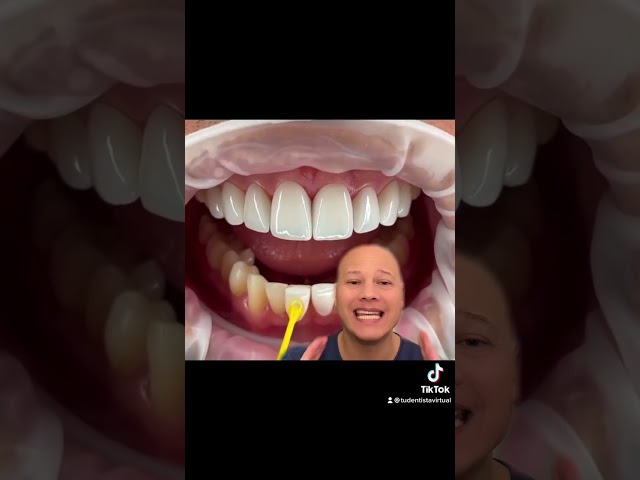 Carillas dentales de cerámica, debes saberlo…