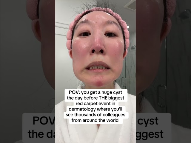 How to Shrink a Cystic Pimple FAST! Dermatologist’s Emergency Fix 🚨