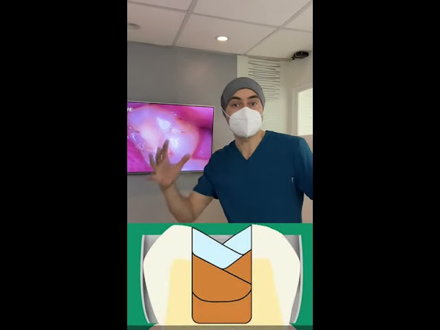 Why does a dental resin/filling fail? #shorts