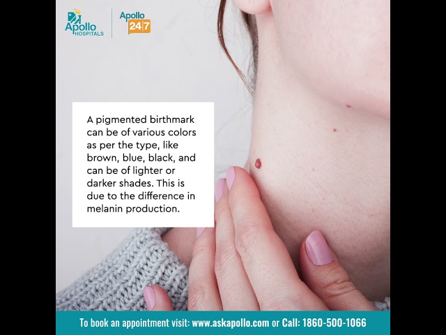 What are pigmented birthmarks? How are pigmented birthmarks diagnosed? | Apollo Hospitals