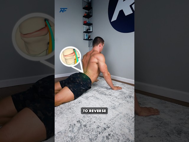 The Worst Way to Fix a Disc Herniation and Sciatica?!