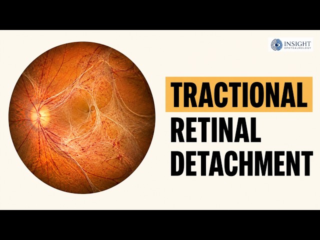 Tractional Retinal Detachment Explained | Pathogenesis, Diagnosis, OCT, Management & Surgery