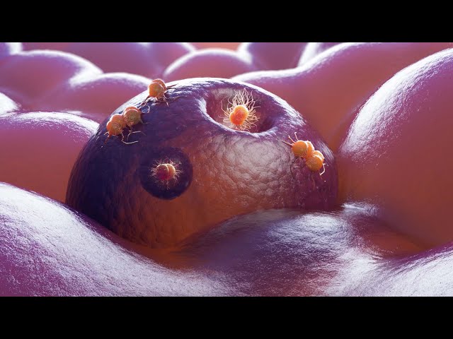 STDs: Gonorrhea