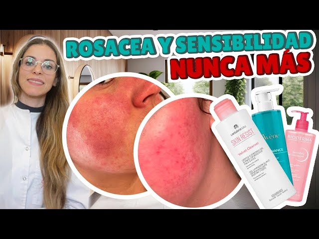 ELIMINA LA ROSÁCEA PARA SIEMPRE