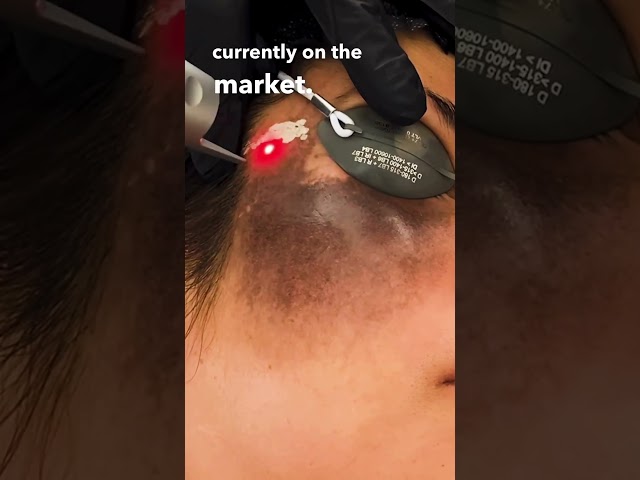 THIS Laser Can Erase Birthmarks! (Birthmark Treatment/Hyperpigmentation)  #laserskincare