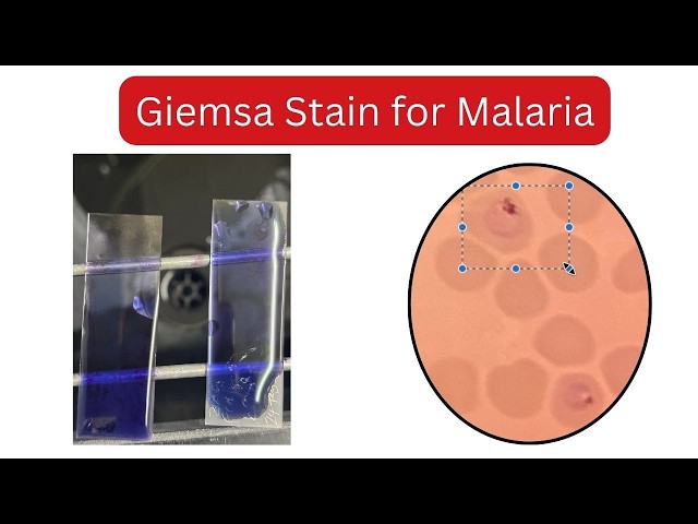 HOW TO IDENTIFY MALARIA UNDER MICROSCOPE | Giemsa stain | Methylene Blue
