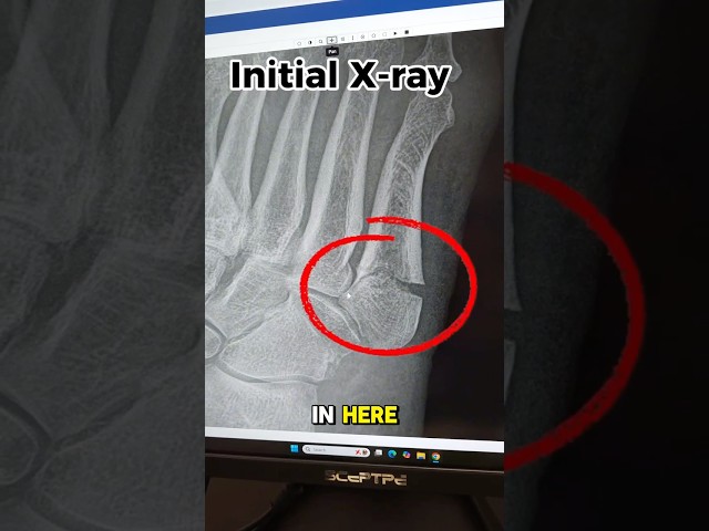 Learn how a few millimeters can impact a fracture’s recovery. Today’s video on a #jonesfracture