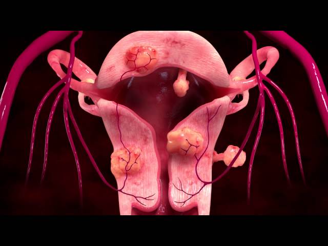 Uterine Fibroid Embolization Treatment