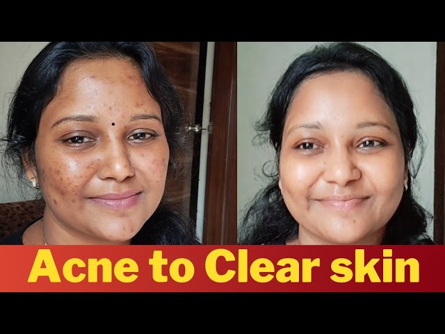 Get rid of Acne !!! Follow this routine consistently #acne #acneproneskin #pimple #clearskin