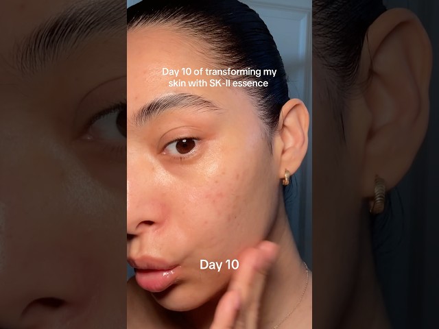Transforming my skin with SK-II essence #essence #japaneseskincare #skincaretransformation