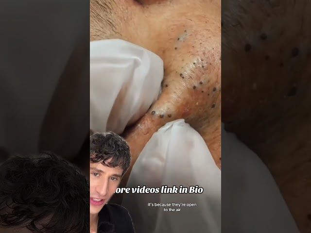 Why blackheads happen. #dermreacts #skincare #pimplepopping