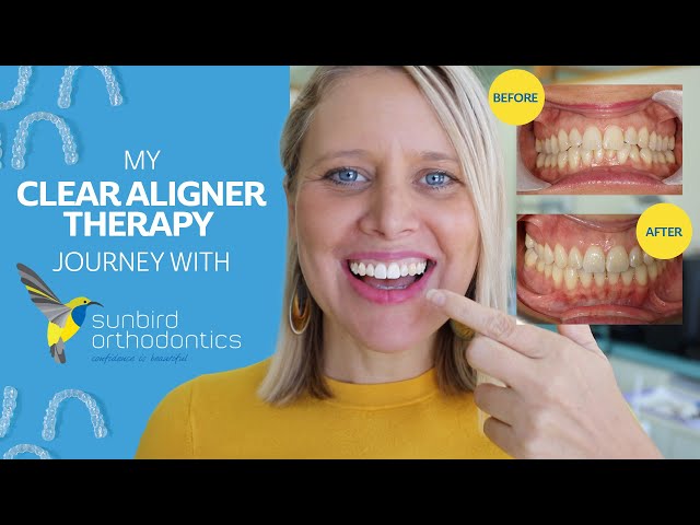 My Invisalign Journey  - Start to Finish