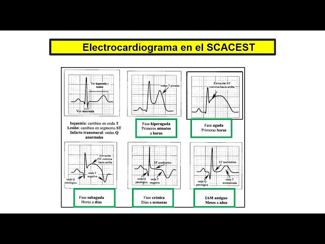 Que debo saber de ECG en SCA para hacer una guardia