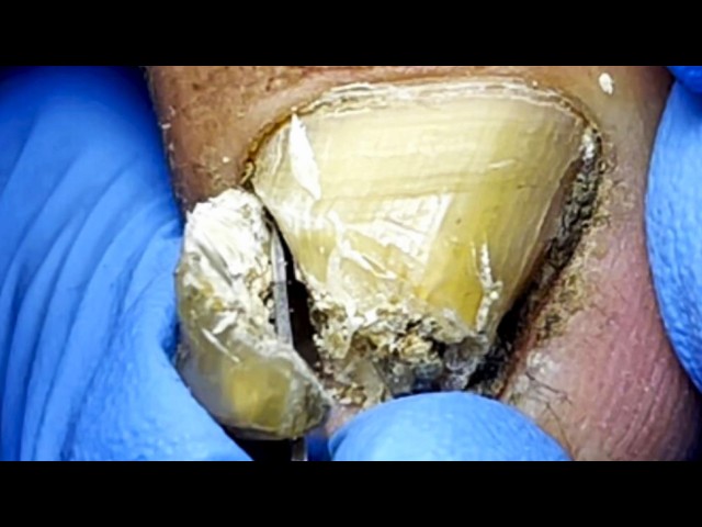 The Onychomycosis Is Like A Stone  Cut Off The Large Ingrown Nails【Pedicure Master Lin Jun】