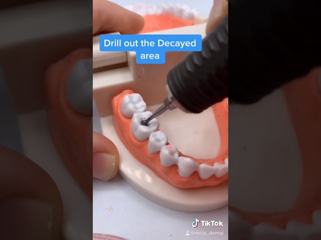 How to Fill a Cavity