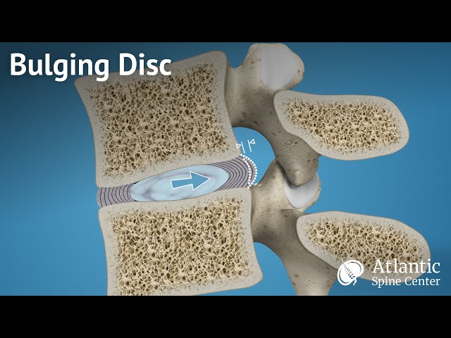 Bulging Disc