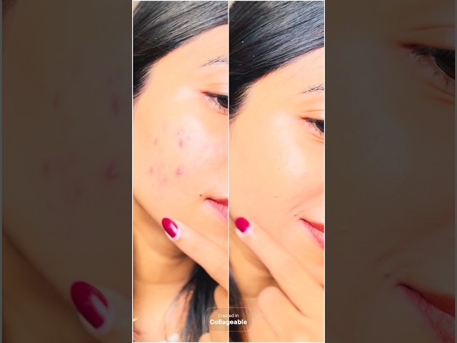 Watch My Acne Marks Disappear in Seconds 😳 #concealer #acnemarks #makeupshorts #acnescars #shorts