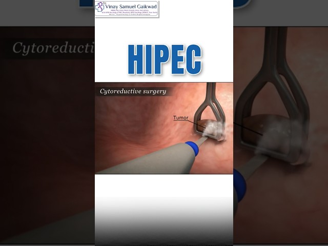 What is HIPEC | Cancer treatment #cancertreatment #hipec