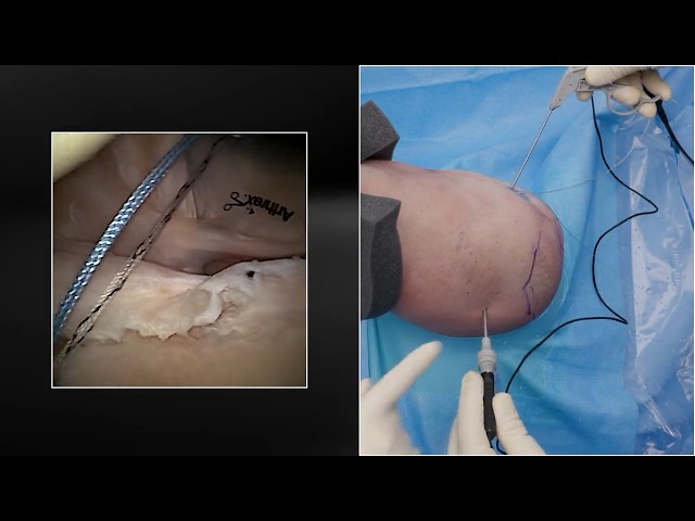 Labral Repair Using the NanoNeedle™ Scope 2.0 and the PassPort Button™ Cannula With Auxiliary Lumen