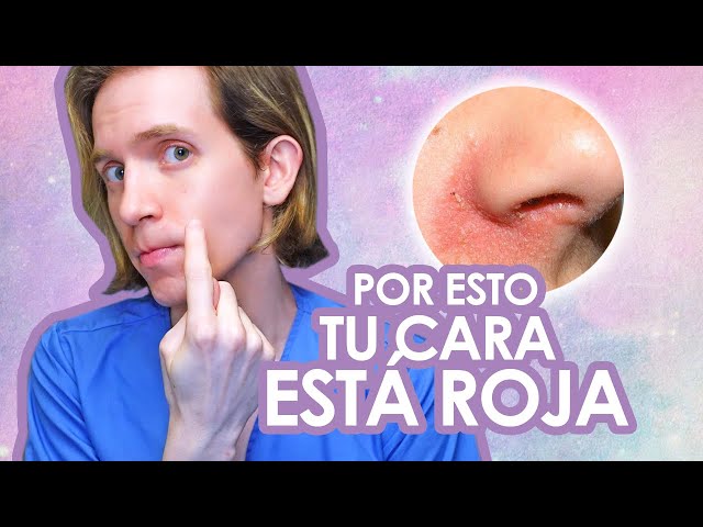 Seborrheic dermatitis: What is it and how is it treated? - Recommendations from a dermatologist