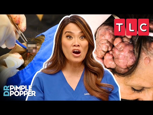 WATCH NOW 🔴 Every. Single. Pop. EVER! | Dr. Pimple Popper | TLC