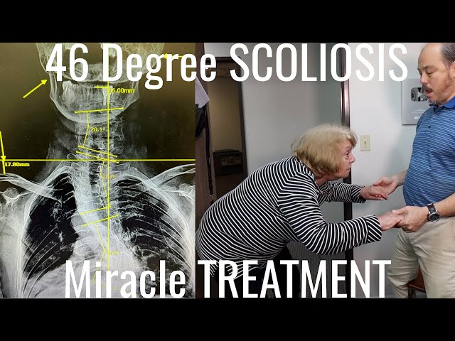 Scoliosis, Knee Arthritis & Can't Walk treated by Chiropractor