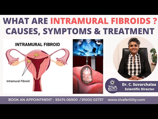 Intramural Fibroid : Causes, Symptoms and Treatment || Dr C Suvarchalaa || ZIVA Fertilityy