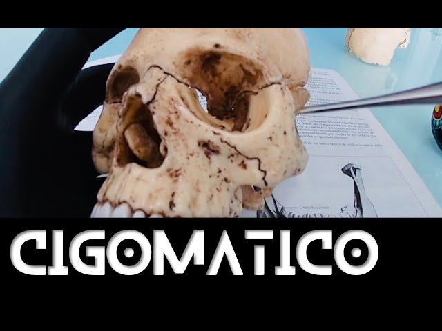 Zygomatic or Malar Bone Anatomy Rouviere Book [Easy to learn]