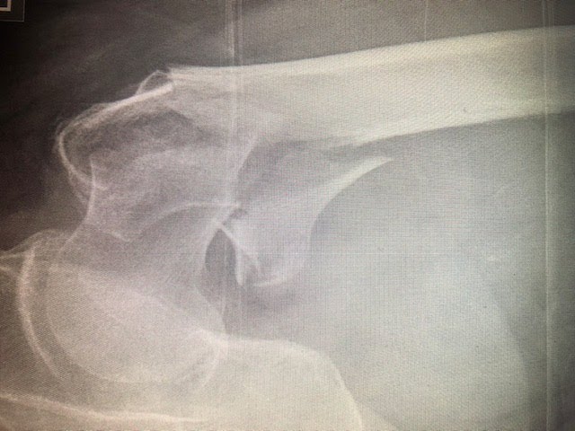 Hip Fractures — Everything You Need To Know