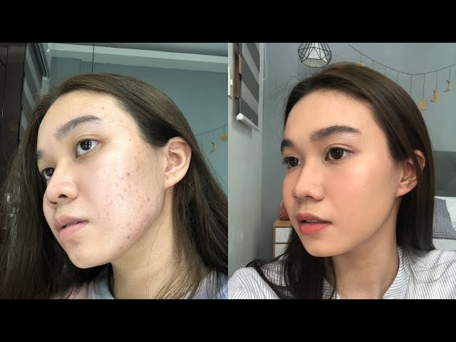 How To Cover Acne Marks/Pimples with No Foundation | Andy Buela (Philippines)