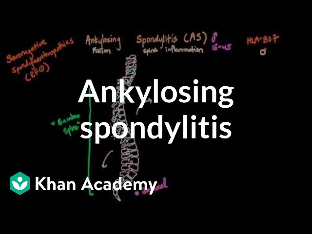 Ankylosing spondylitis | Muscular-skeletal diseases | NCLEX-RN | Khan Academy