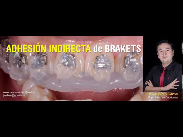 ADHESIÓN INDIRECTA DE BRACKETS