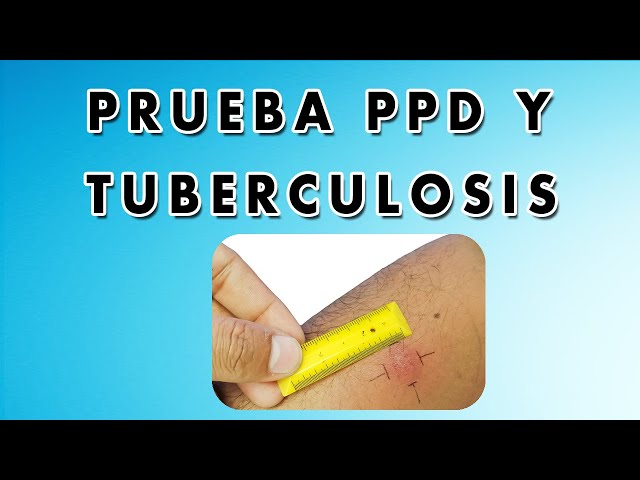 Diagnóstico de la Tuberculosis - Prueba de PPD, Radiografía y Prueba IGRA