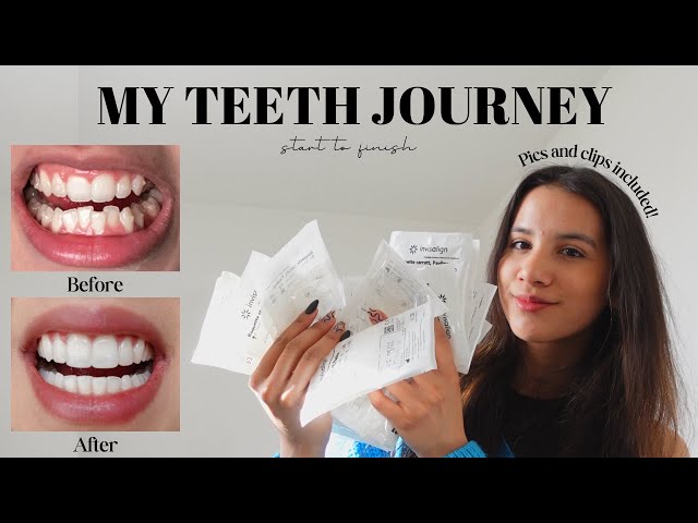 MY TEETH JOURNEY | Invisalign, Composite Bonding, Whitening | Answering All Your Questions