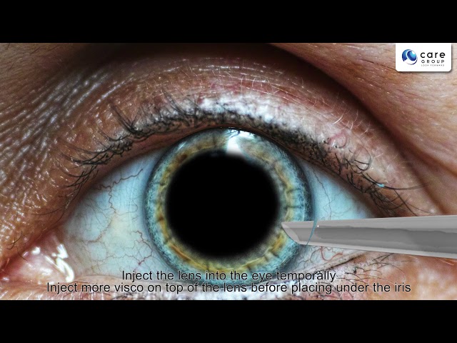 IPCL V2 0 With Notch Animation Video