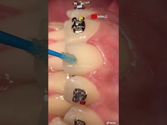 “INSTALACIÓN de BRACKETS metálicos y hules con orejas”